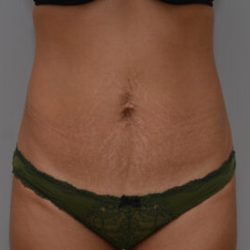 Abdominoplasty Before & After Patient #1441