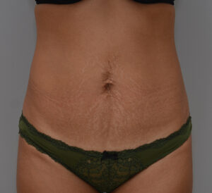 Abdominoplasty Before & After Patient #1441