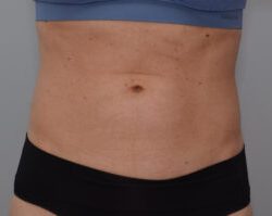 Emsculpt Neo Before & After Patient #2173