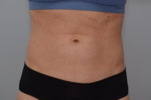 Emsculpt Neo Before & After Patient #2173