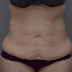 Body Lift Before & After Patient #1545