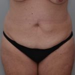 Abdominoplasty Before & After Patient #1444