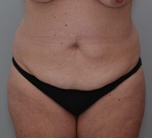 Abdominoplasty Before & After Patient #1444