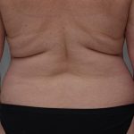 Liposuction with Bodytite Before & After Patient #1556