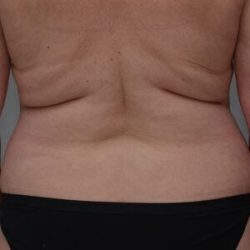 Liposuction with Bodytite Before & After Patient #1556