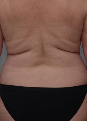 Bodytite Before & After Patient #1556