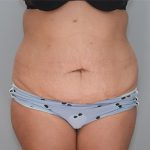 Abdominoplasty Before & After Patient #1273