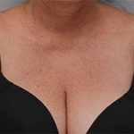 Laser Skin Resurfacing Before & After Patient #2231