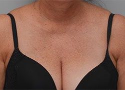 Laser Skin Resurfacing Before & After Patient #2231