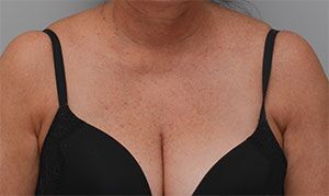 Laser Skin Resurfacing Before & After Patient #2231