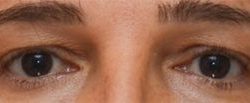 Blepharoplasty Before & After Patient #1702