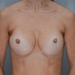 Breast Implant Exchange Before & After Patient #863