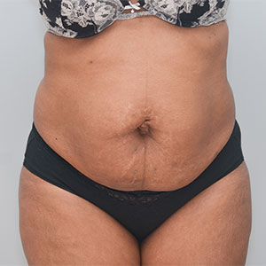 Abdominoplasty Before & After Patient #1384