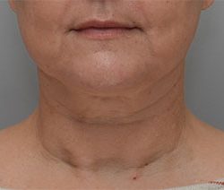 Facetite Before & After Patient #1880