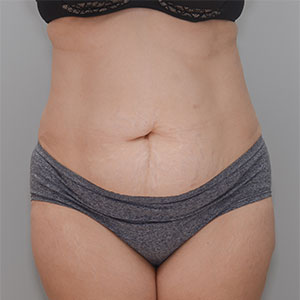 Abdominoplasty Before & After Patient #1383