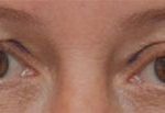 Blepharoplasty Before & After Patient #1701