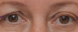 Blepharoplasty Before & After Patient #1701