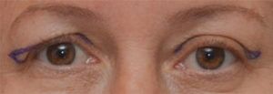 Blepharoplasty Before & After Patient #1701