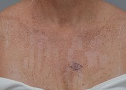 Laser Skin Resurfacing Before & After Patient #2229