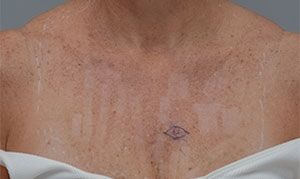 Laser Skin Resurfacing Before & After Patient #2229