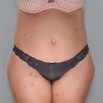 Abdominoplasty Before & After Patient #1329