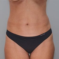 Abdominoplasty Before & After Patient #1328