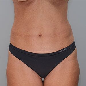 Abdominoplasty Before & After Patient #1328