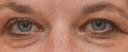 Blepharoplasty Before & After Patient #1700