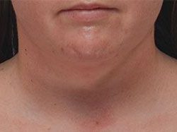 Neck Liposuction Before & After Patient #1951