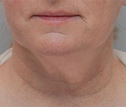 Facetite Before & After Patient #1778