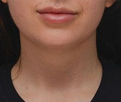 Neck Liposuction Before & After Patient #1950