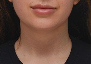 Neck Liposuction Before & After Patient #1950