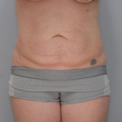 Abdominoplasty Before & After Patient #1272