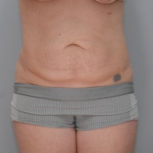 Abdominoplasty Before & After Patient #1272