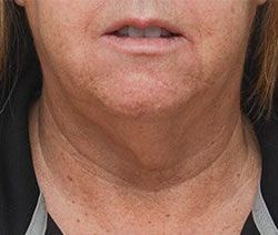 Facetite Before & After Patient #1882