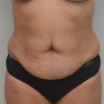 Abdominoplasty Before & After Patient #1386