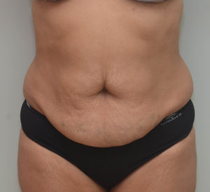 Abdominoplasty Before & After Patient #1386