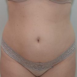 Abdominoplasty Before & After Patient #1385