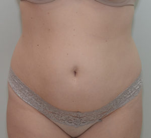 Abdominoplasty Before & After Patient #1385