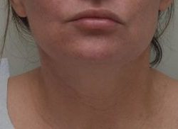 Neck Liposuction Before & After Patient #2003