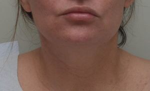 Neck Liposuction Before & After Patient #2003