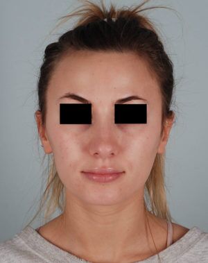 Rhinoplasty Before & After Patient #2113