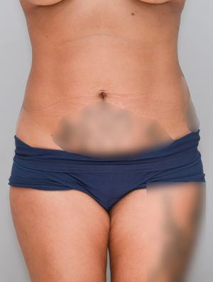 Abdominoplasty Before & After Patient #1269