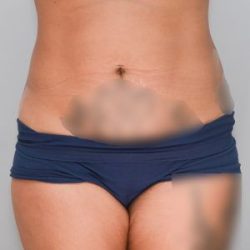Abdominoplasty Before & After Patient #1641