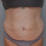 Abdominoplasty Before & After Patient #1211