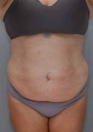 Abdominoplasty Before & After Patient #1211