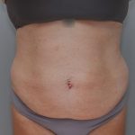 Abdominoplasty Before & After Patient #1590
