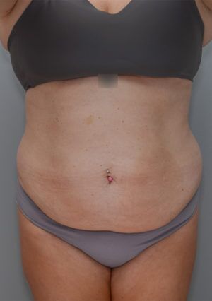 Liposuction Before & After Patient #1590