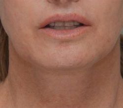 Facetite Before & After Patient #1780