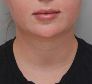 Neck Liposuction Before & After Patient #1949